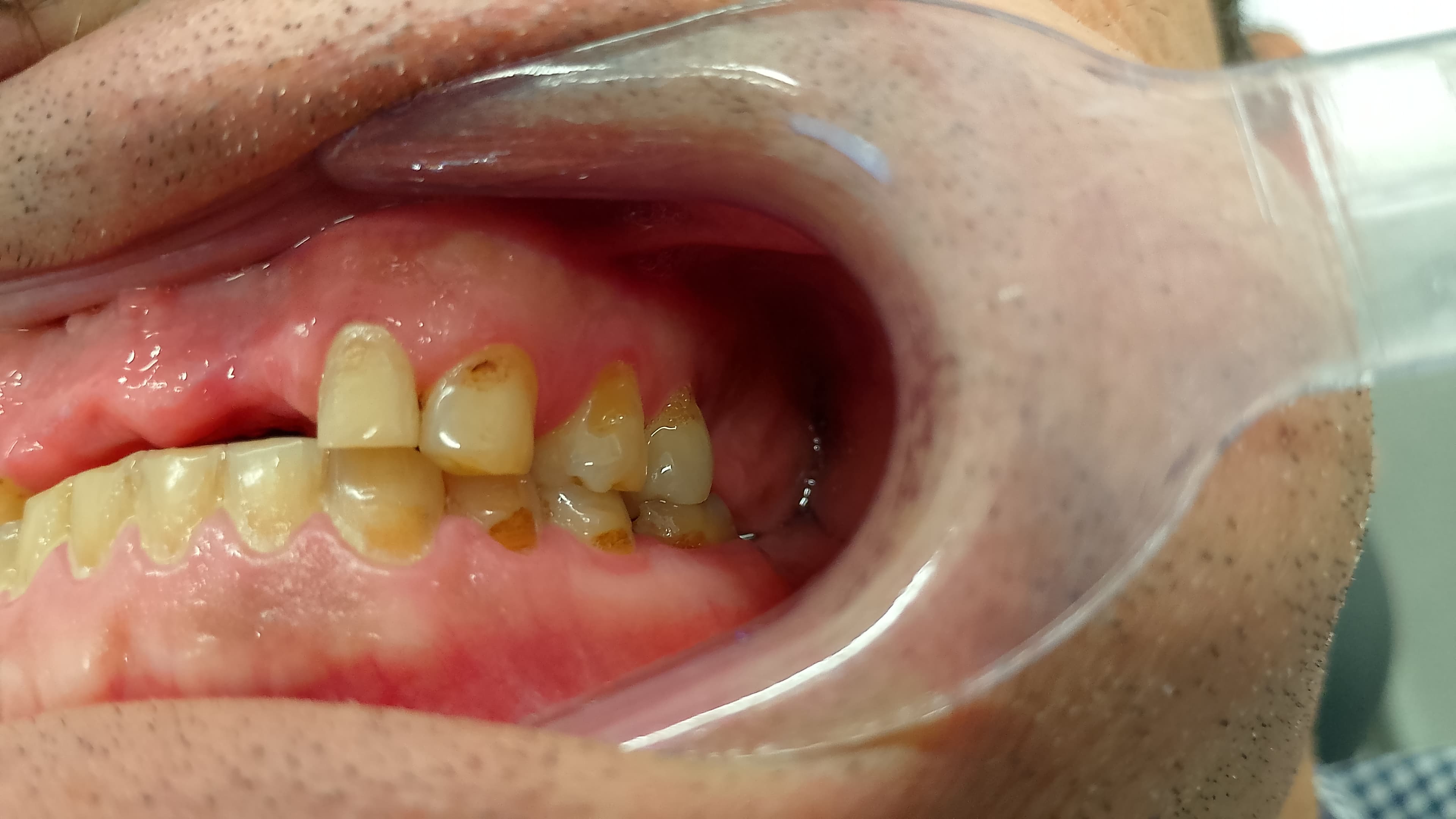 Gonzalo Alzueta - Prótesis